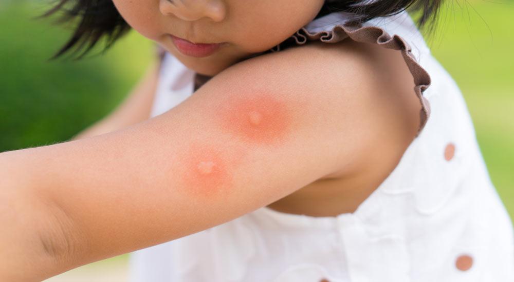 Como tratar picadas de insetos em bebês e crianças?